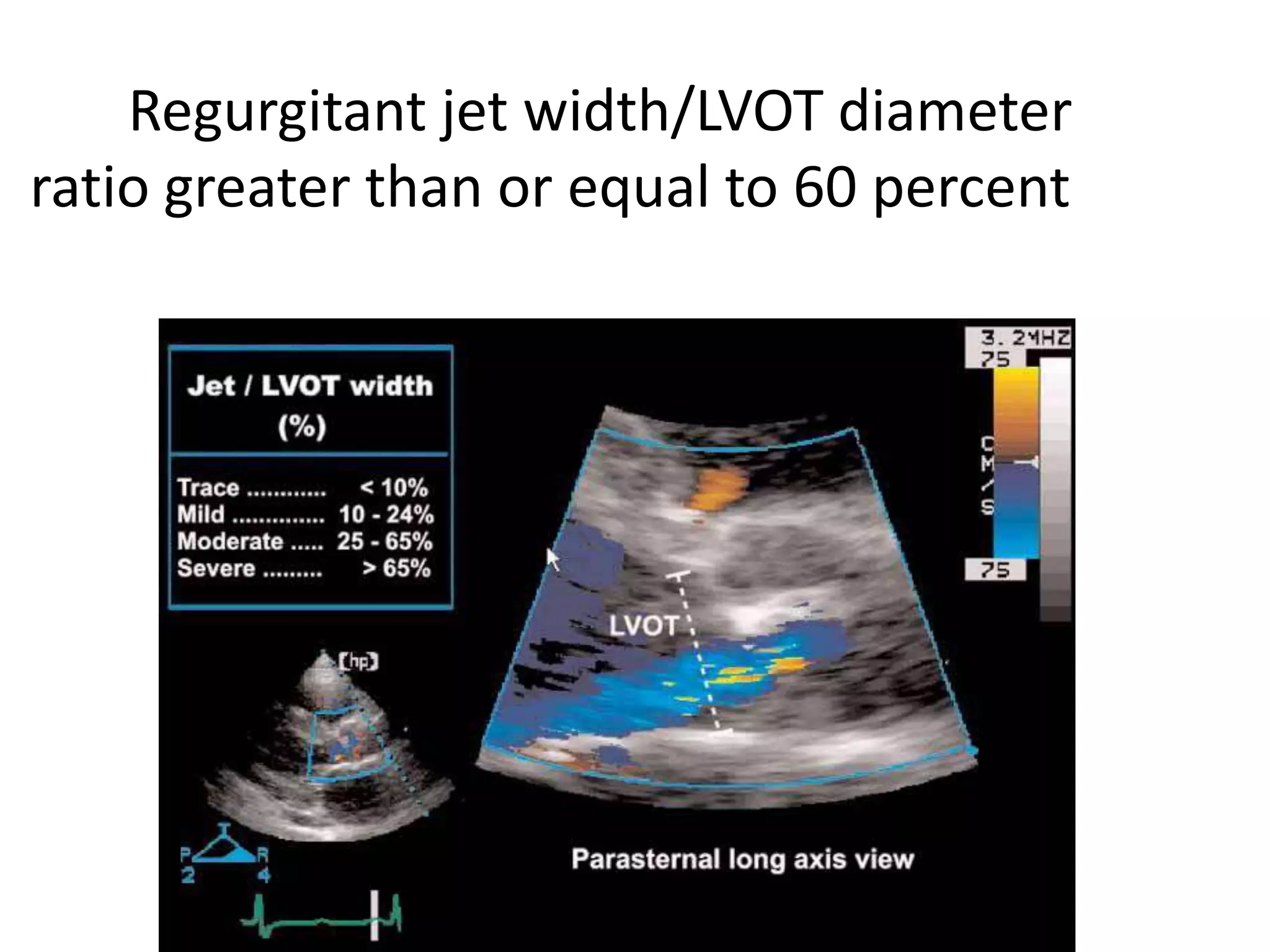 Regurgitant jet width/LVOT diameter 
ratio greater than or equal to 60 percent 
 