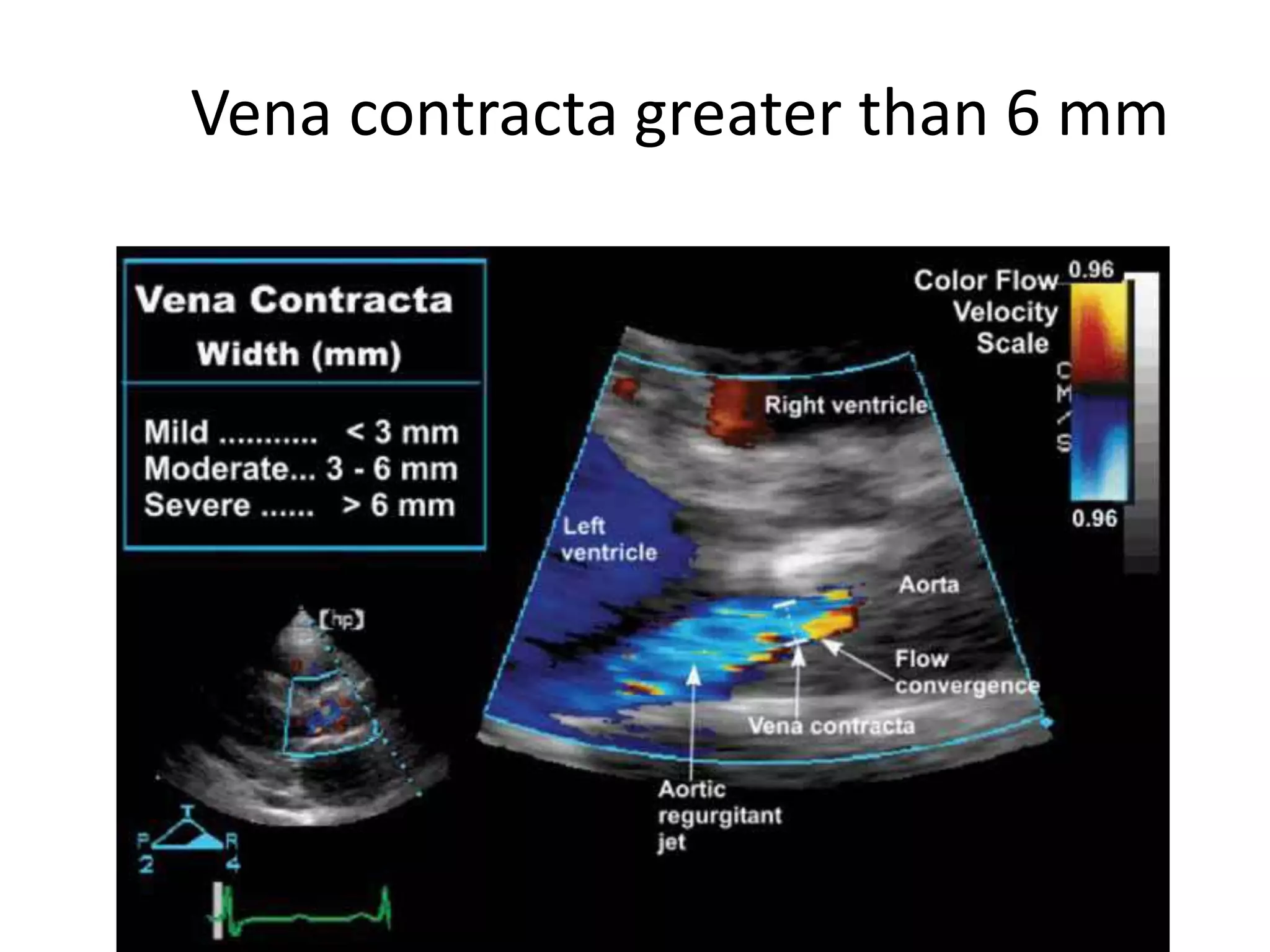 Vena contracta greater than 6 mm 
 