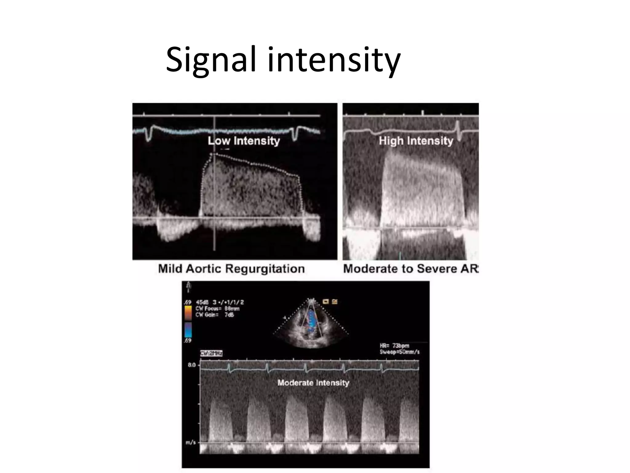Signal intensity 
 