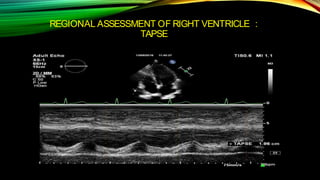 REGIONAL ASSESSMENT OF RIGHT VENTRICLE :
TAPSE
 