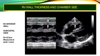 RV WALL THICKNESS AND CHAMBER SIZE
RV INFERIOR
WALL
SUBCOSTAL
VIEW
N=<0.5cm
Measured at
peak r wave
 