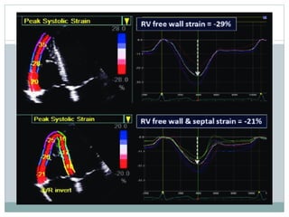 ECHO ASSESMENT OF RV FUNCTION AND PAH fin1.pptx