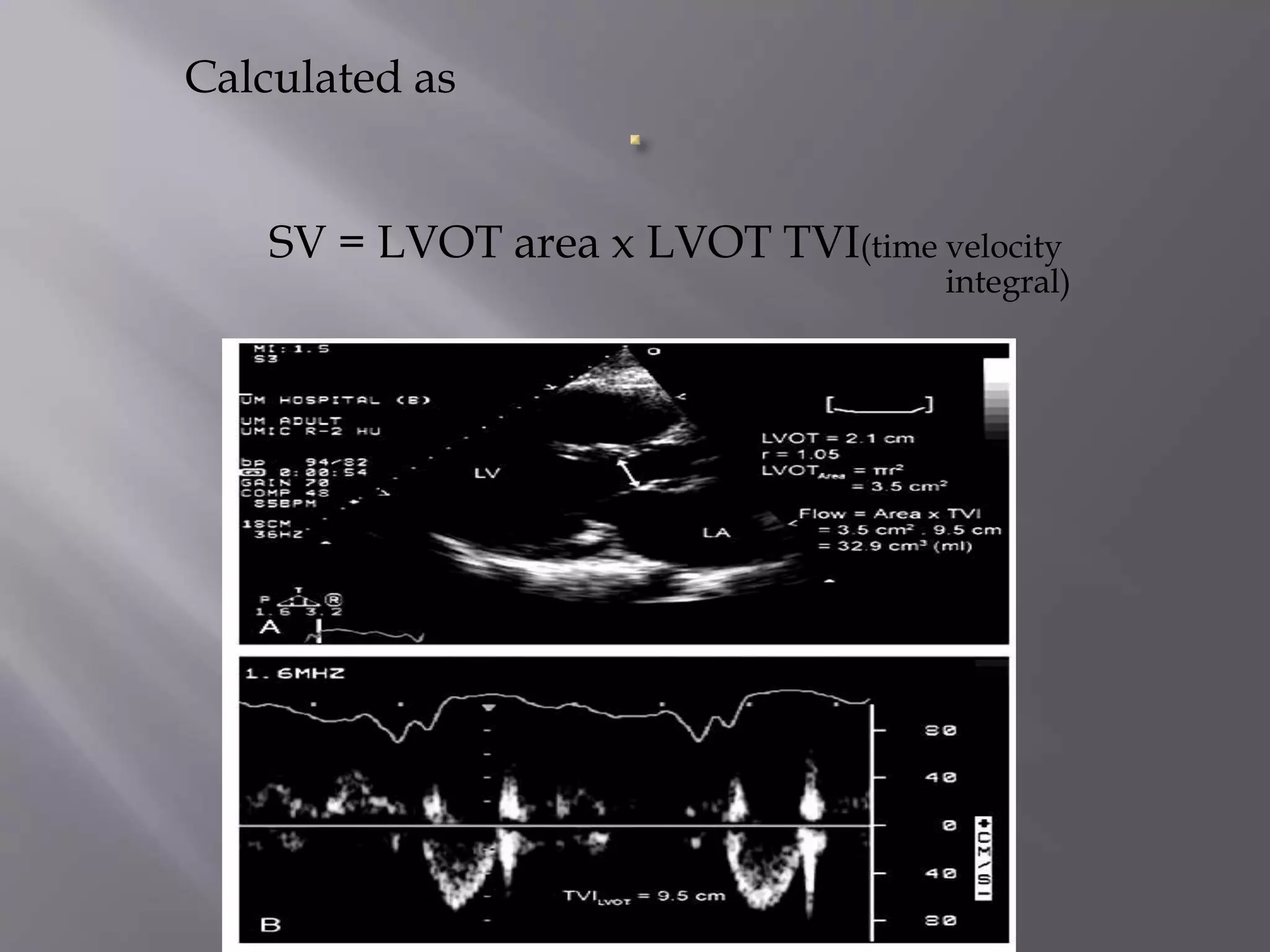 Calculated as
SV = LVOT area x LVOT TVI(time velocity
integral)
 