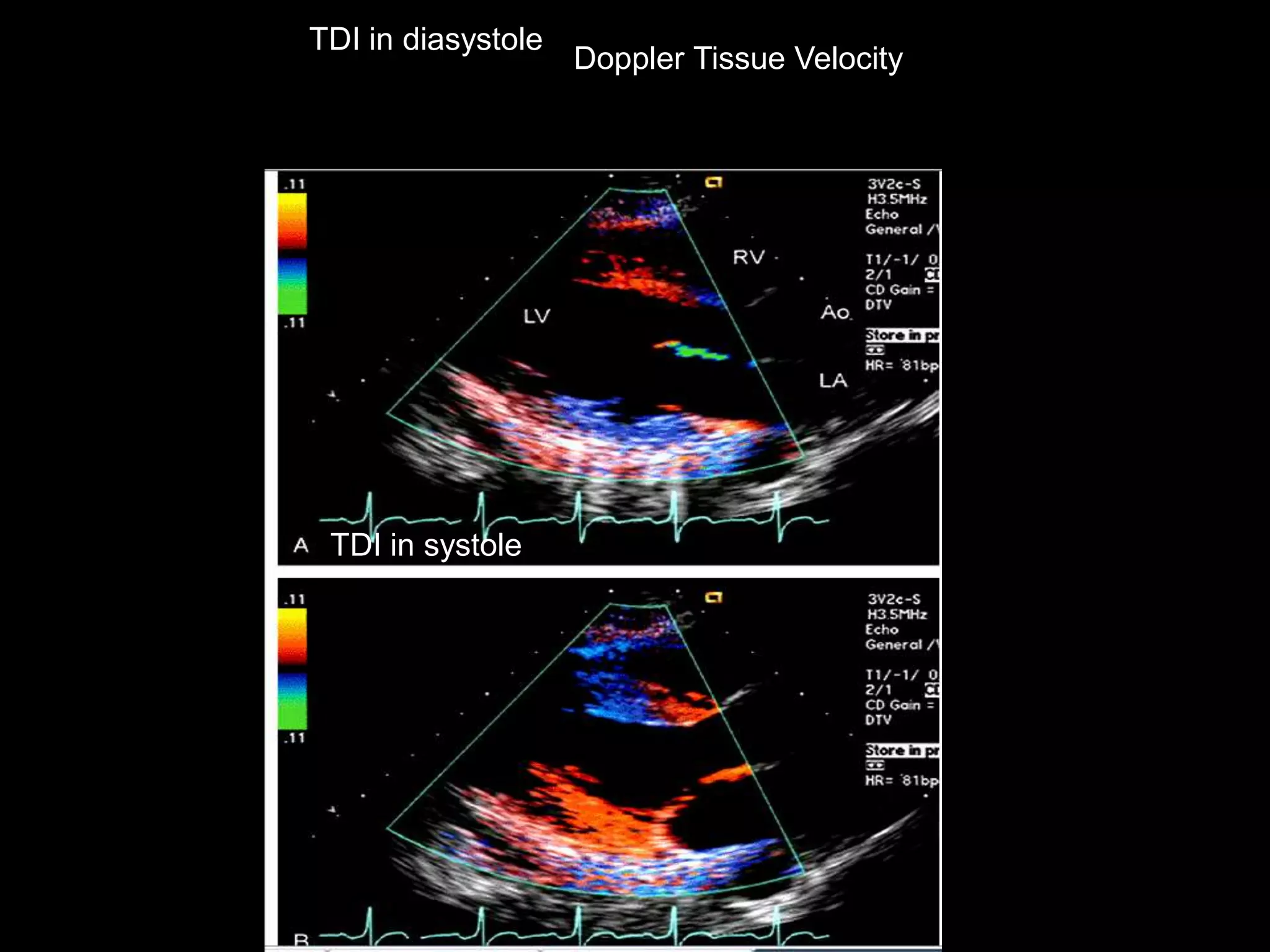 TDI in systole
TDI in diasystole
Doppler Tissue Velocity
 