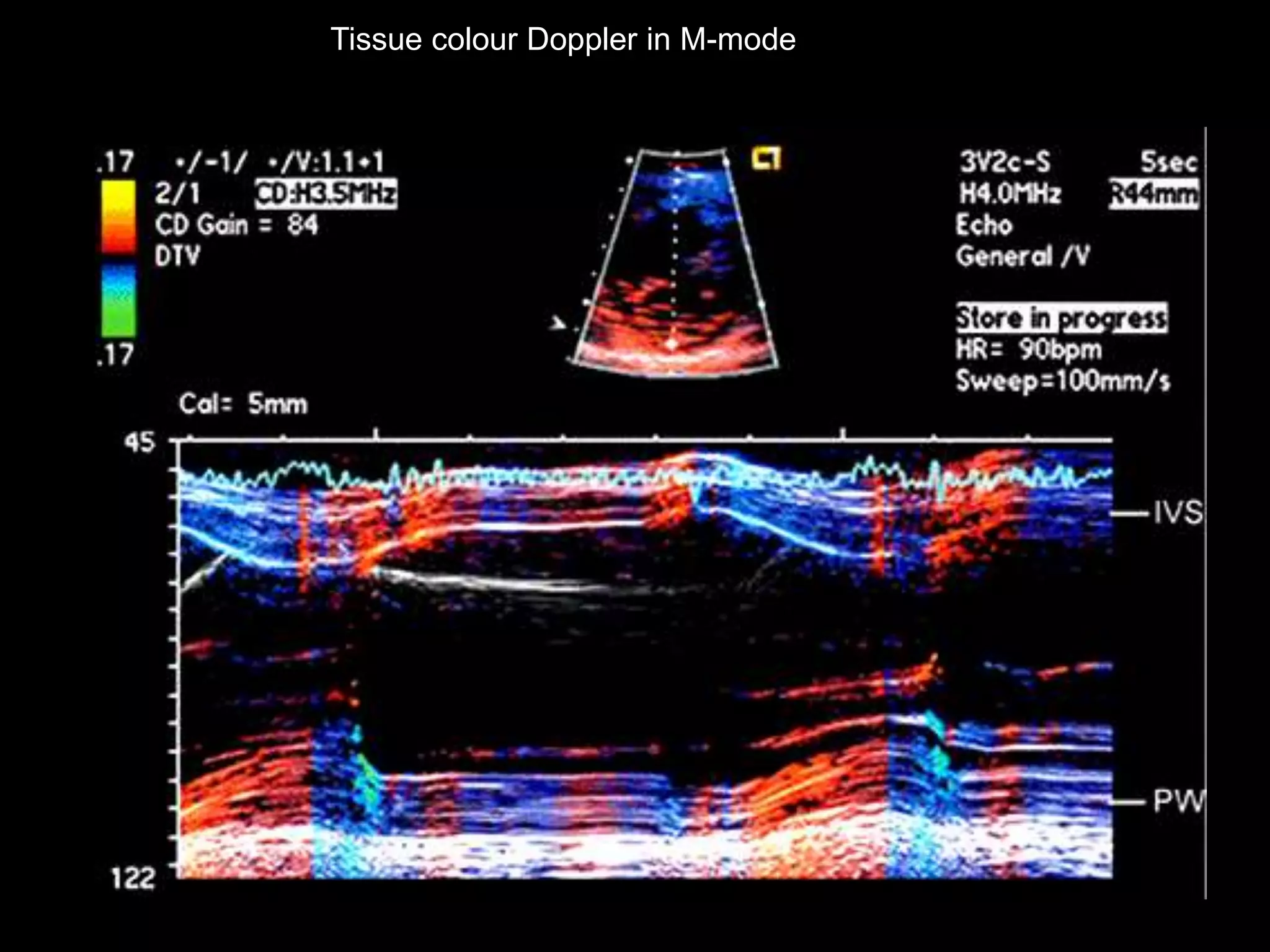 Tissue colour Doppler in M-mode
 