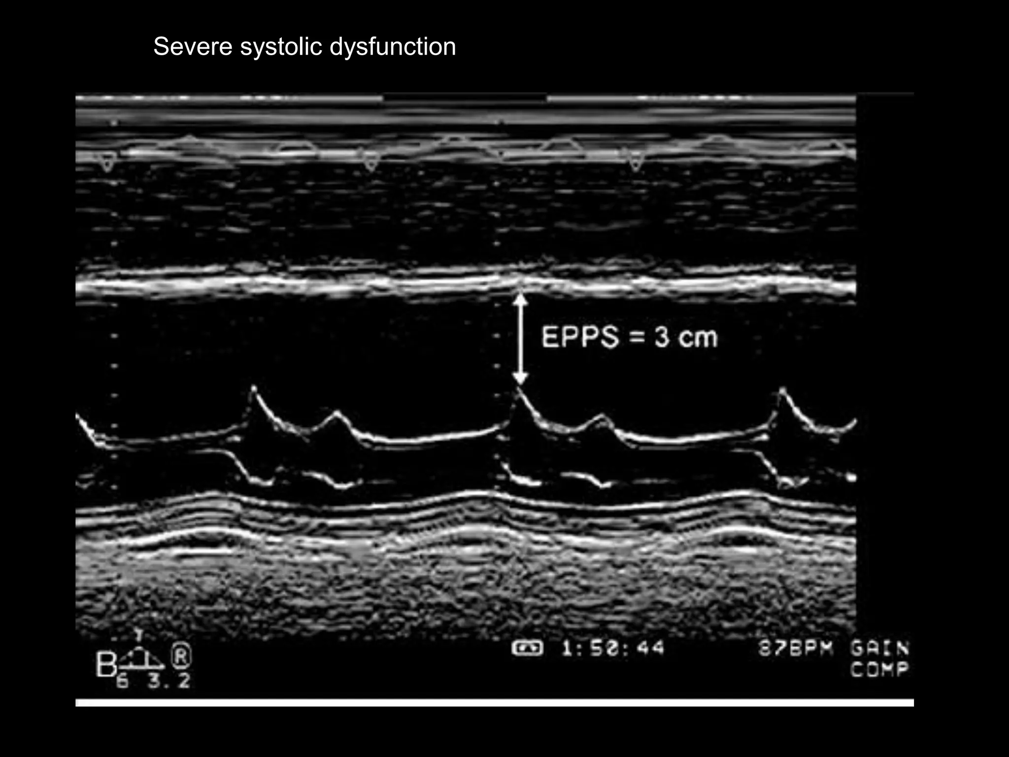 Severe systolic dysfunction
 
