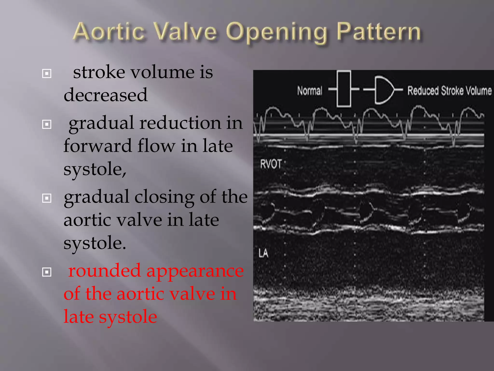  stroke volume is
decreased
 gradual reduction in
forward flow in late
systole,
 gradual closing of the
aortic valve in late
systole.
 rounded appearance
of the aortic valve in
late systole
 