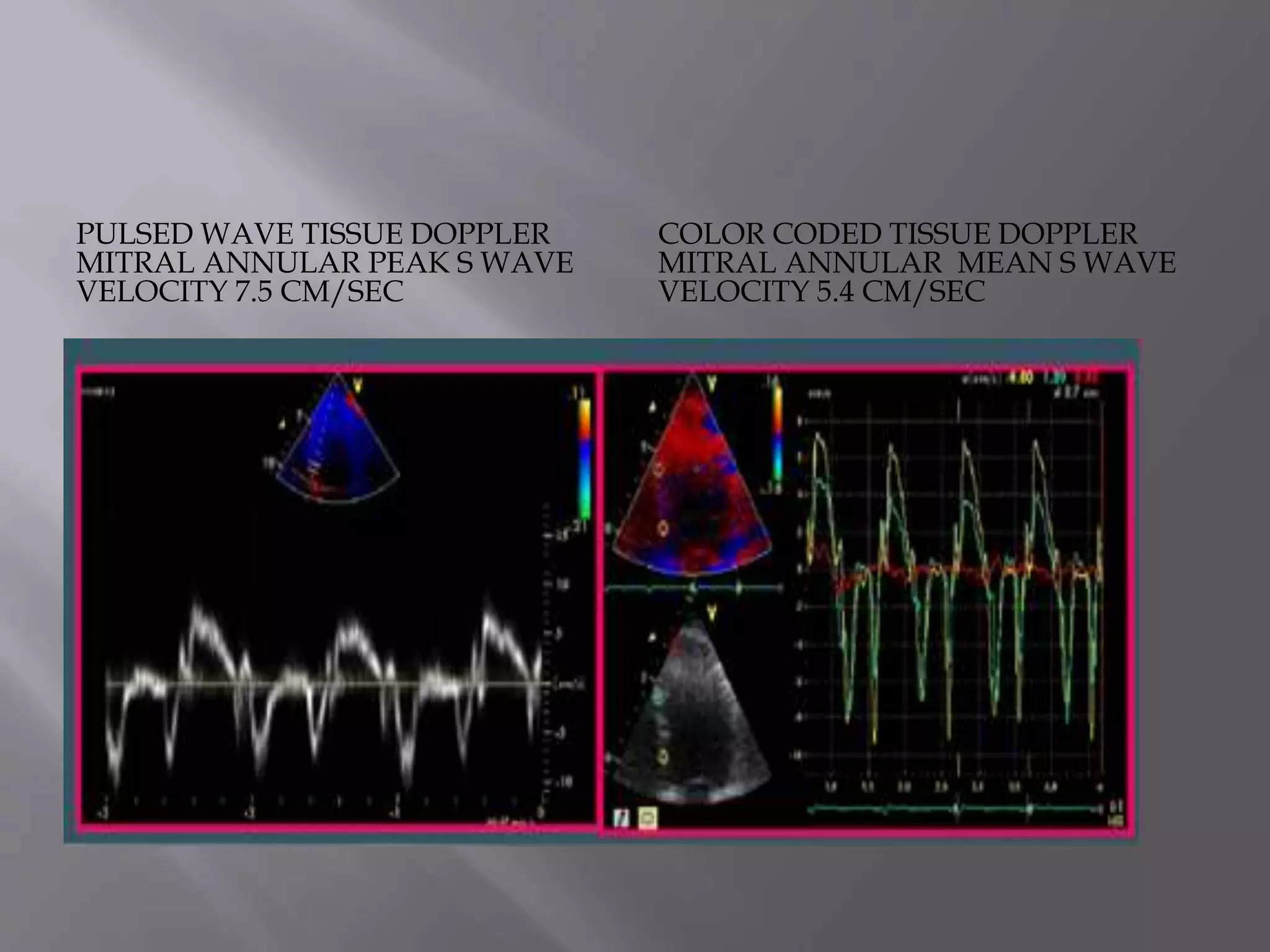 PULSED WAVE TISSUE DOPPLER
MITRAL ANNULAR PEAK S WAVE
VELOCITY 7.5 CM/SEC
COLOR CODED TISSUE DOPPLER
MITRAL ANNULAR MEAN S WAVE
VELOCITY 5.4 CM/SEC
 