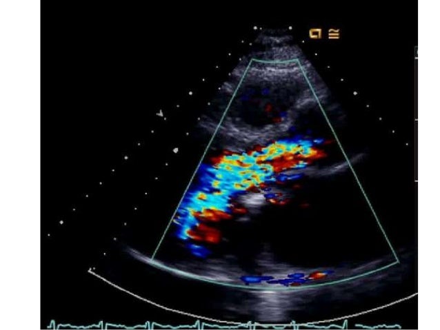 echo-assessment-of-aortic-regurgitation