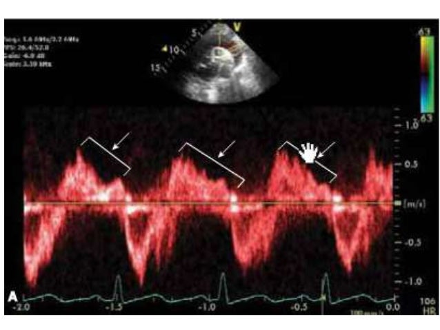 echo-assessment-of-aortic-regurgitation