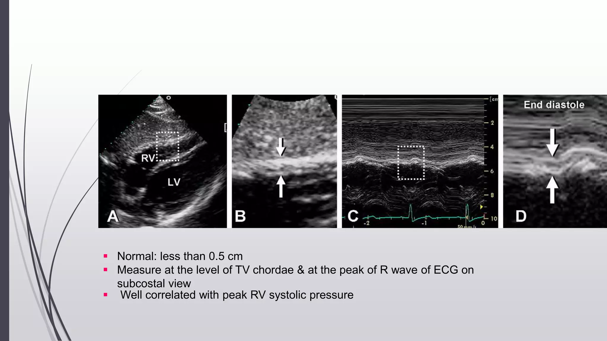  Normal: less than 0.5 cm
 Measure at the level of TV chordae & at the peak of R wave of ECG on
subcostal view
 Well correlated with peak RV systolic pressure
 