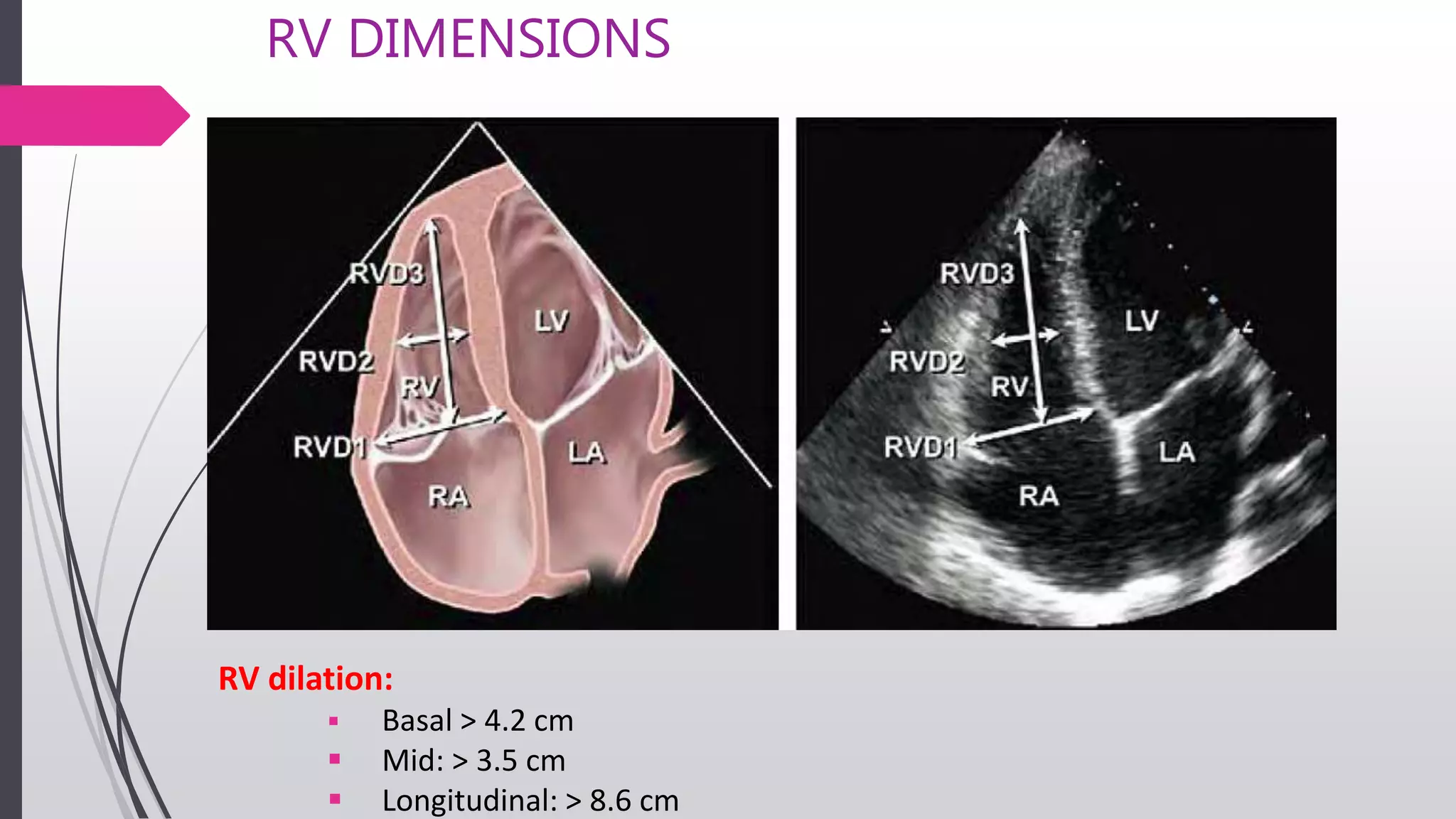 RV DIMENSIONS
RV dilation:
 Basal > 4.2 cm
 Mid: > 3.5 cm
 Longitudinal: > 8.6 cm
 