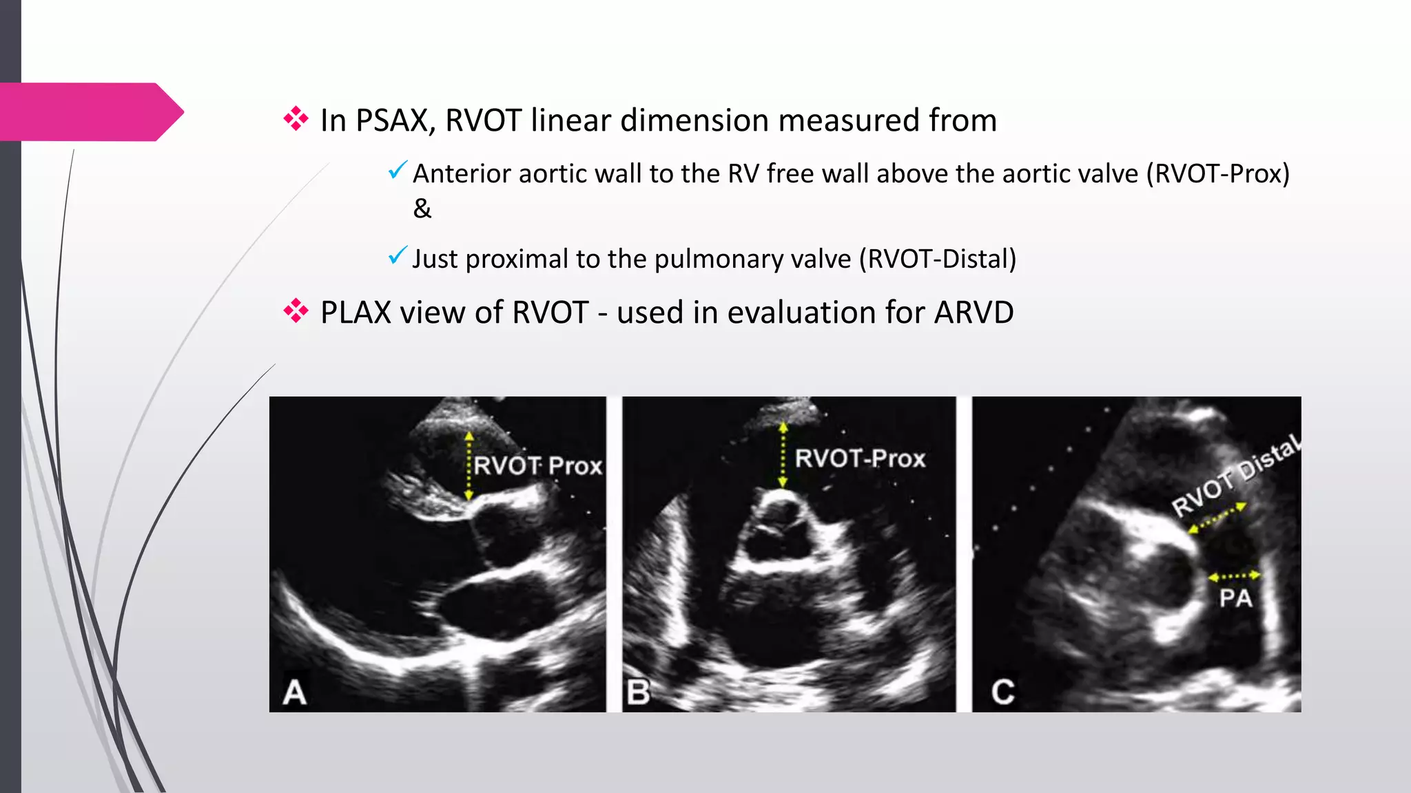  In PSAX, RVOT linear dimension measured from
Anterior aortic wall to the RV free wall above the aortic valve (RVOT-Prox)
&
Just proximal to the pulmonary valve (RVOT-Distal)
 PLAX view of RVOT - used in evaluation for ARVD
 