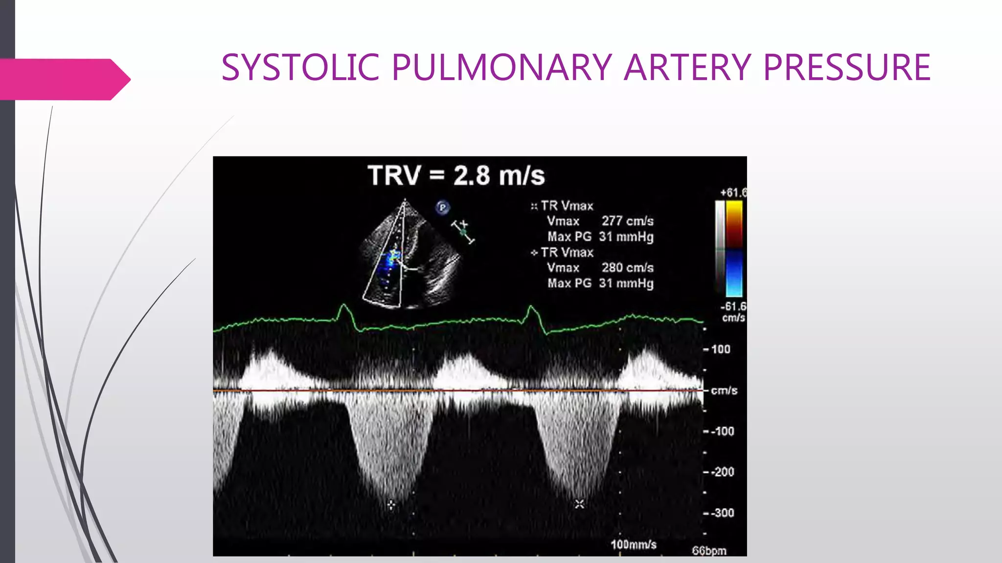SYSTOLIC PULMONARY ARTERY PRESSURE
 