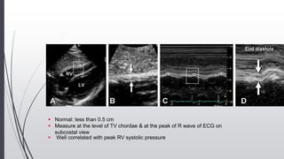  Normal: less than 0.5 cm
 Measure at the level of TV chordae & at the peak of R wave of ECG on
subcostal view
 Well correlated with peak RV systolic pressure
 
