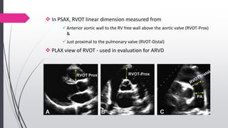  In PSAX, RVOT linear dimension measured from
Anterior aortic wall to the RV free wall above the aortic valve (RVOT-Prox)
&
Just proximal to the pulmonary valve (RVOT-Distal)
 PLAX view of RVOT - used in evaluation for ARVD
 