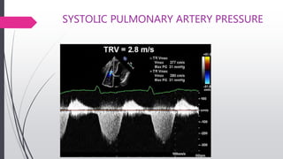 SYSTOLIC PULMONARY ARTERY PRESSURE
 