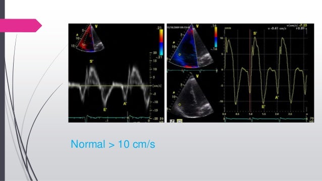 echo-assessment-of-rv-function
