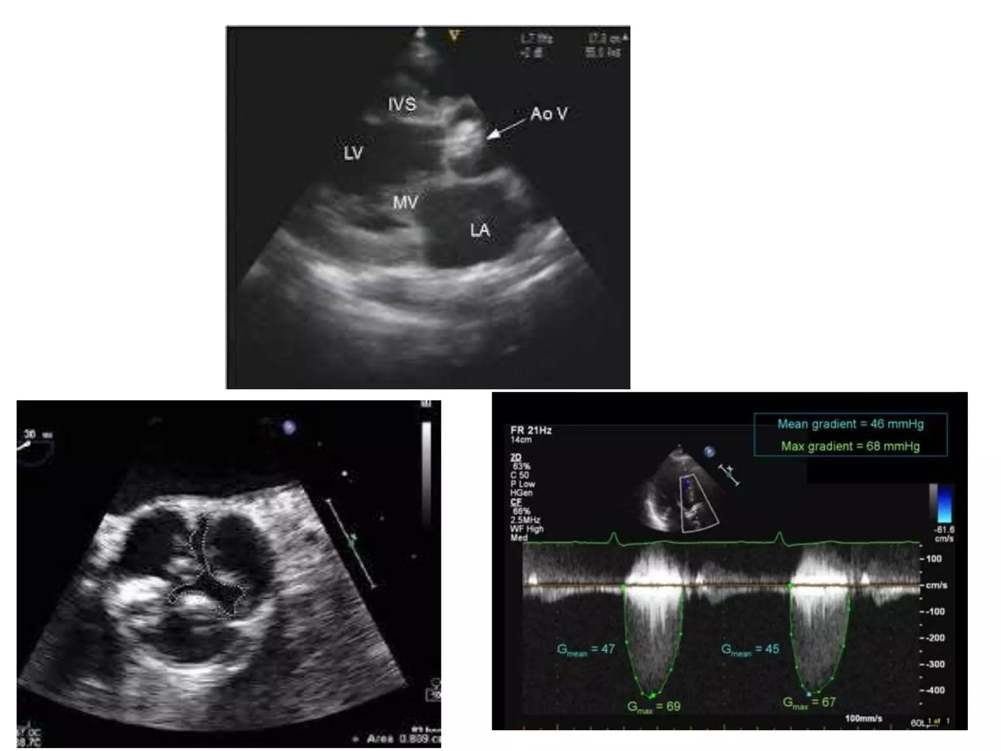 Basics of echocardiography | PDF