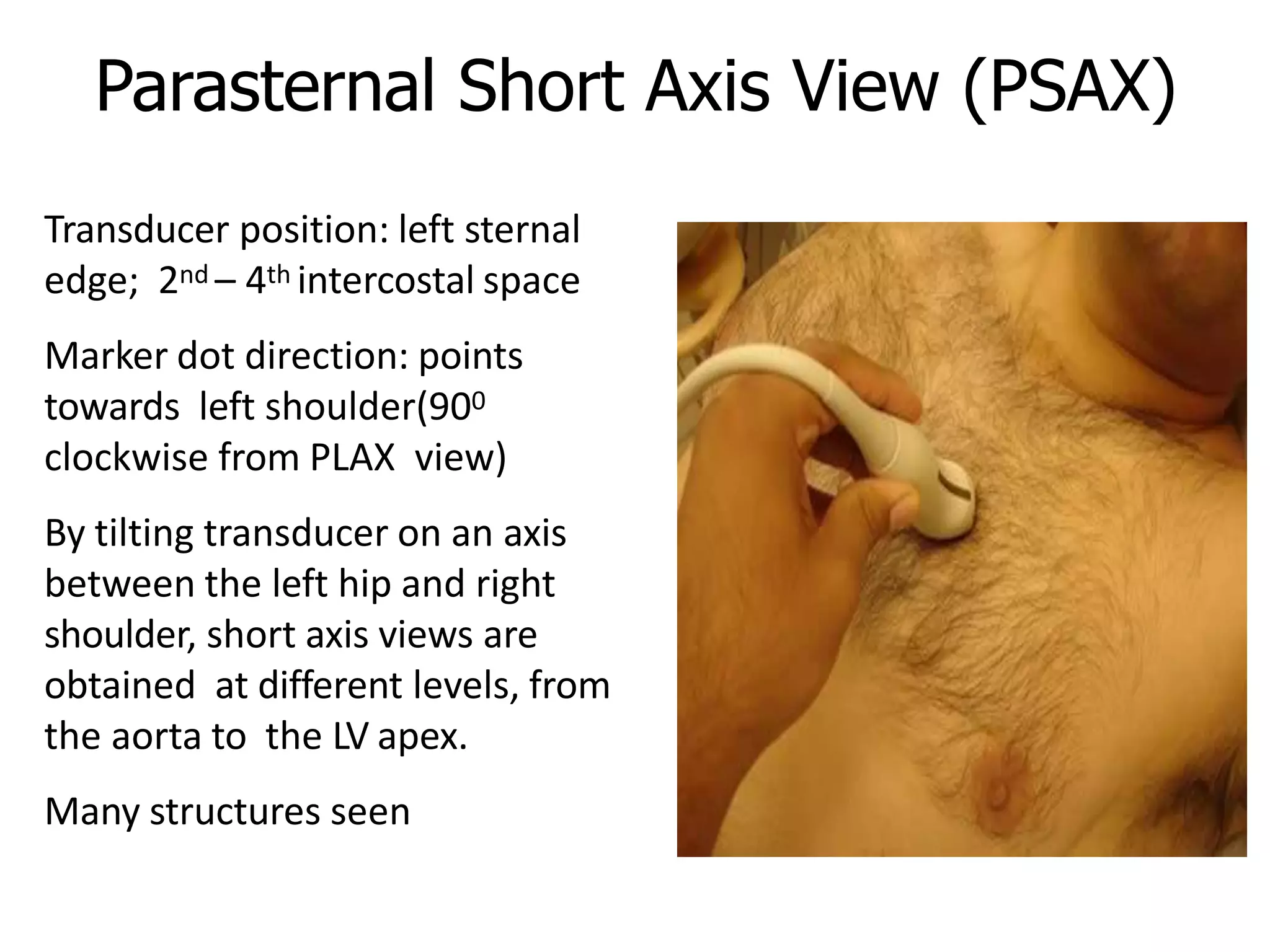 Parasternal Short Axis View (PSAX)
Transducer position: left sternal
edge; 2nd – 4th intercostal space
Marker dot direction: points
towards left shoulder(900
clockwise from PLAX view)
By tilting transducer on an axis
between the left hip and right
shoulder, short axis views are
obtained at different levels, from
the aorta to the LV apex.
Many structures seen
22
 