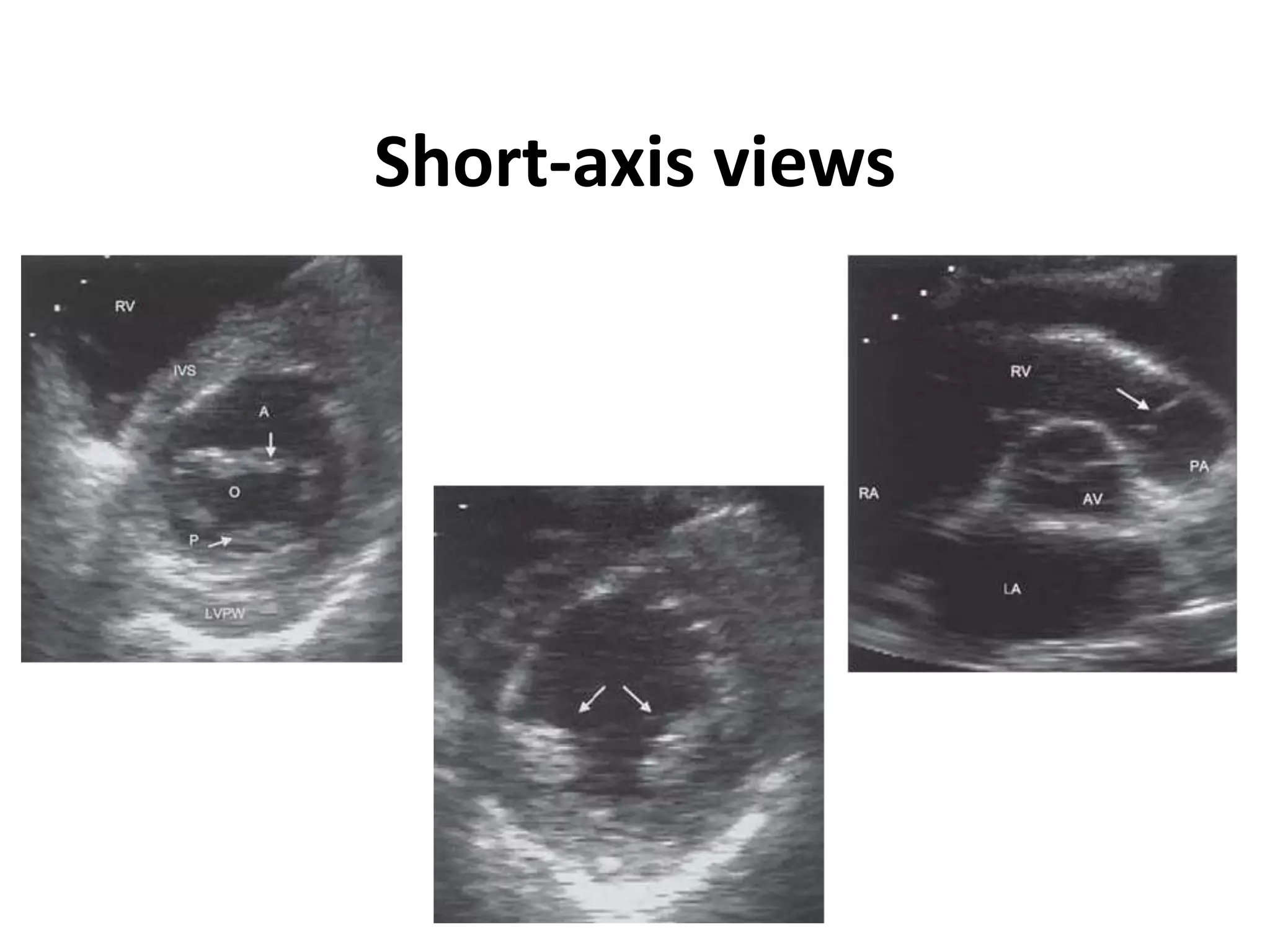 Short-axis views
 