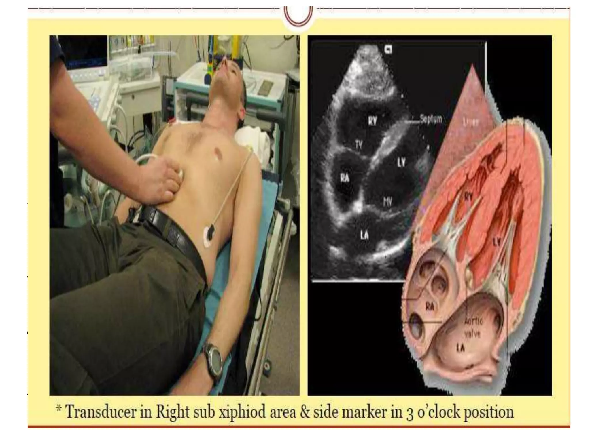 Sub–Costal 4 Chamber View(SC4CH)
1. Transducer position: under the
xiphisternum
2. Marker dot position: points towards left
shoulder.
3. The subject lies supine with head slightly low (no pillow). With
feet on the bed, the knees are slightly elevated
4. Better images are obtained with the abdomen relaxed and
during inspiration
5. Interatrial septum, pericardial effusion, desc abdominal aorta
 