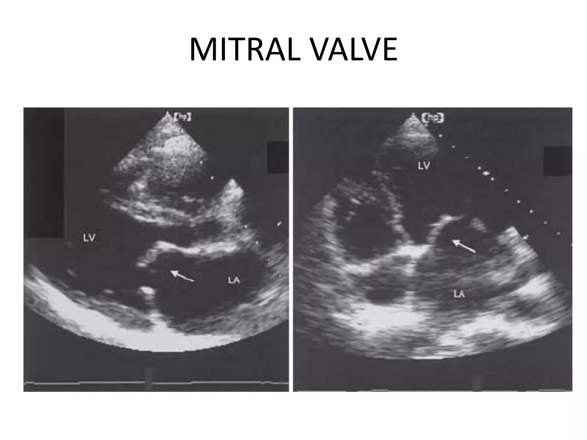 MITRAL VALVE
 