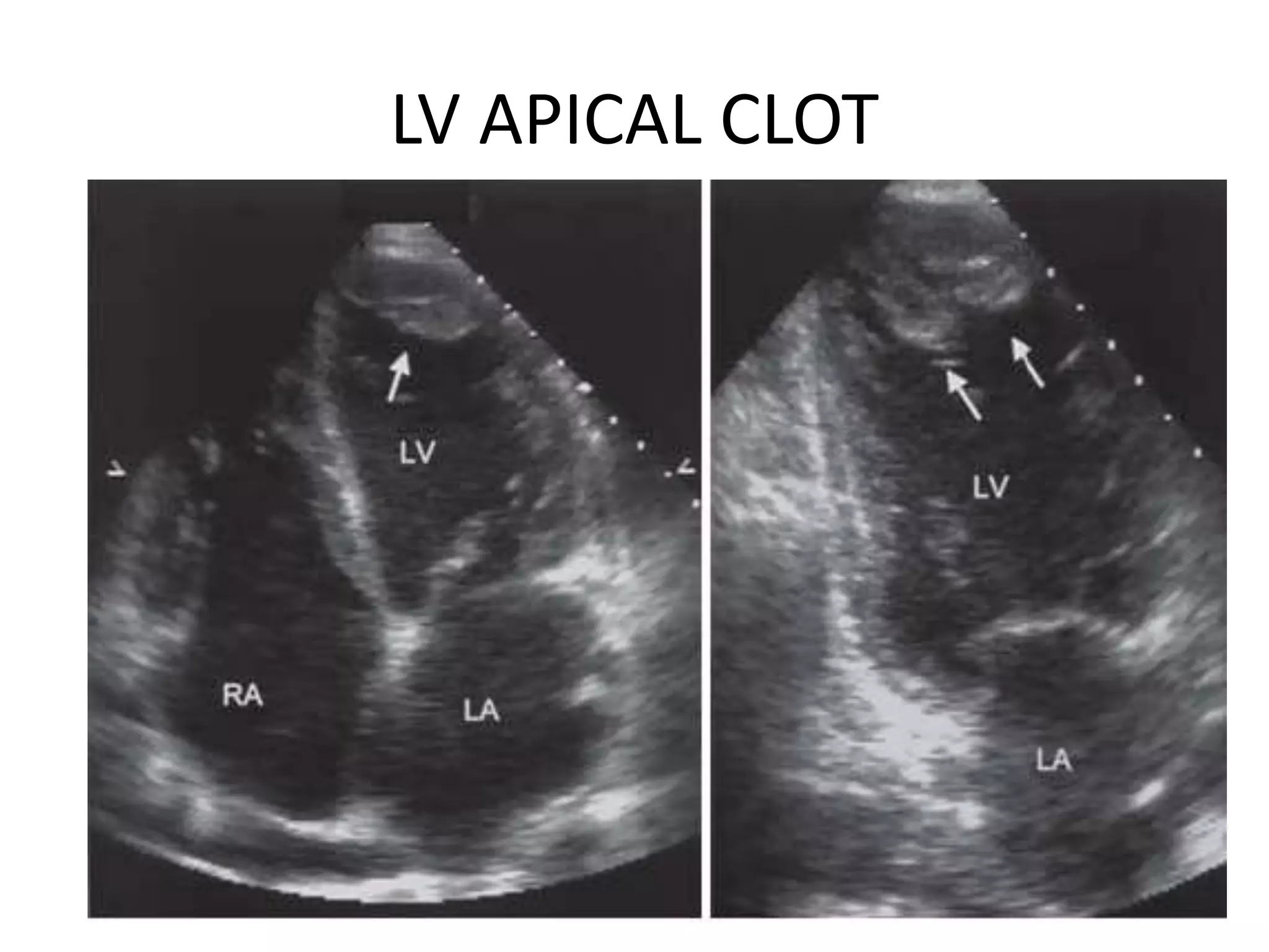 LV APICAL CLOT
 