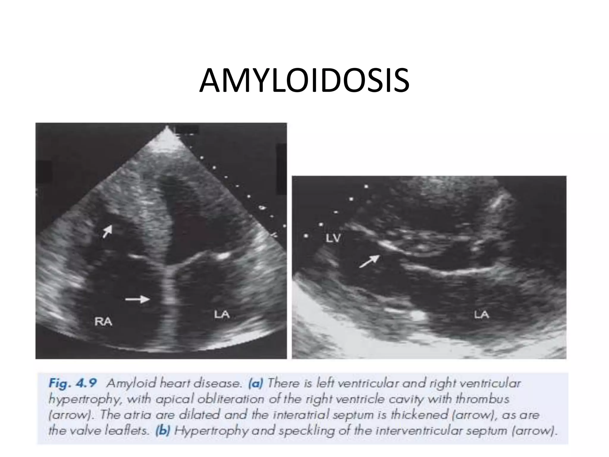 AMYLOIDOSIS
 