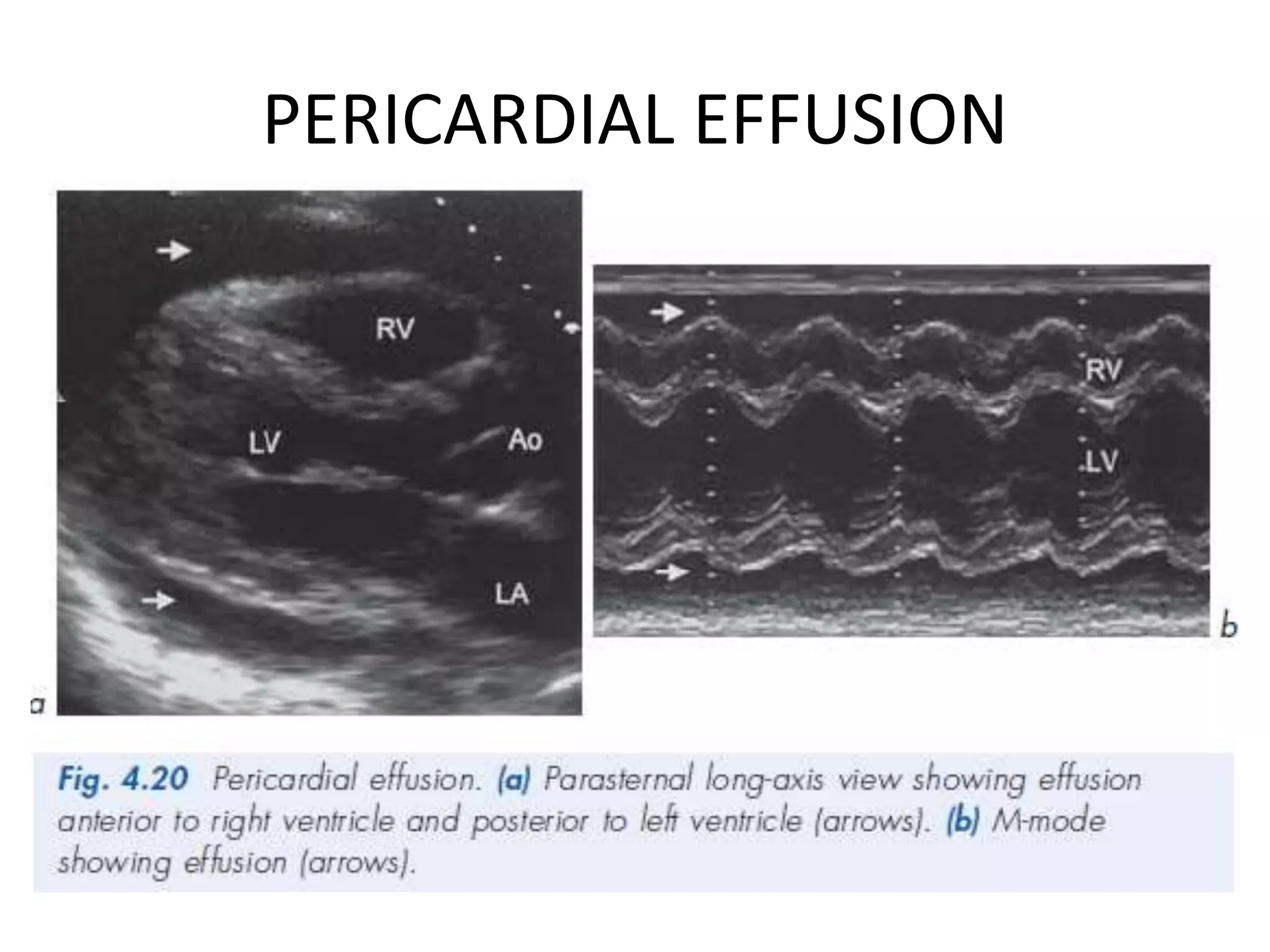 PERICARDIAL EFFUSION
 