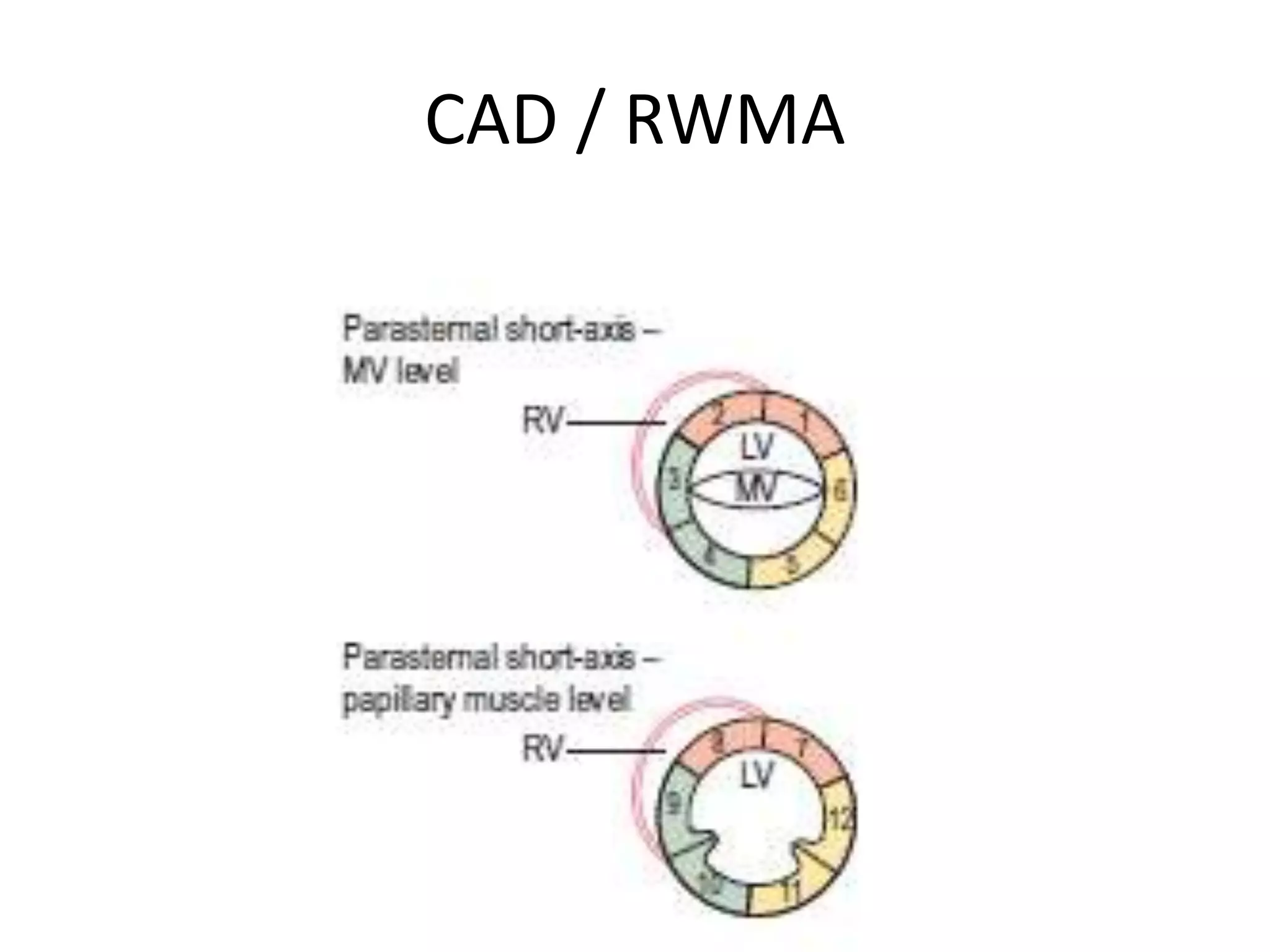 CAD / RWMA
 