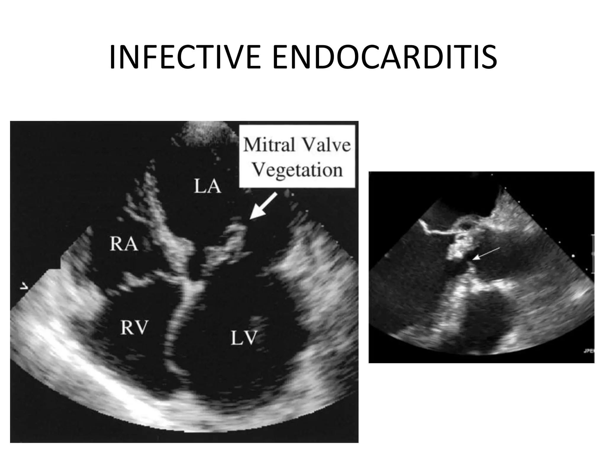 INFECTIVE ENDOCARDITIS
 
