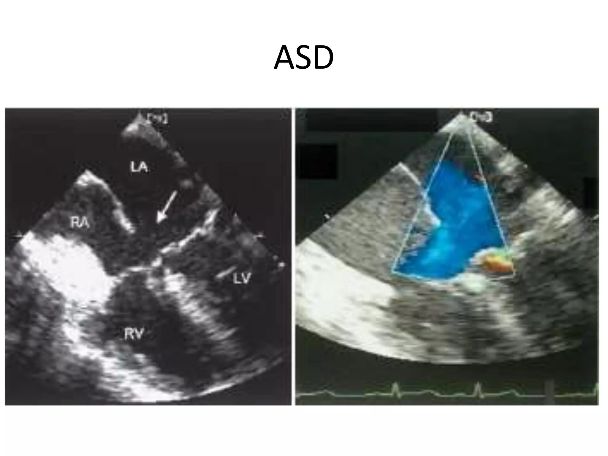ASD
 
