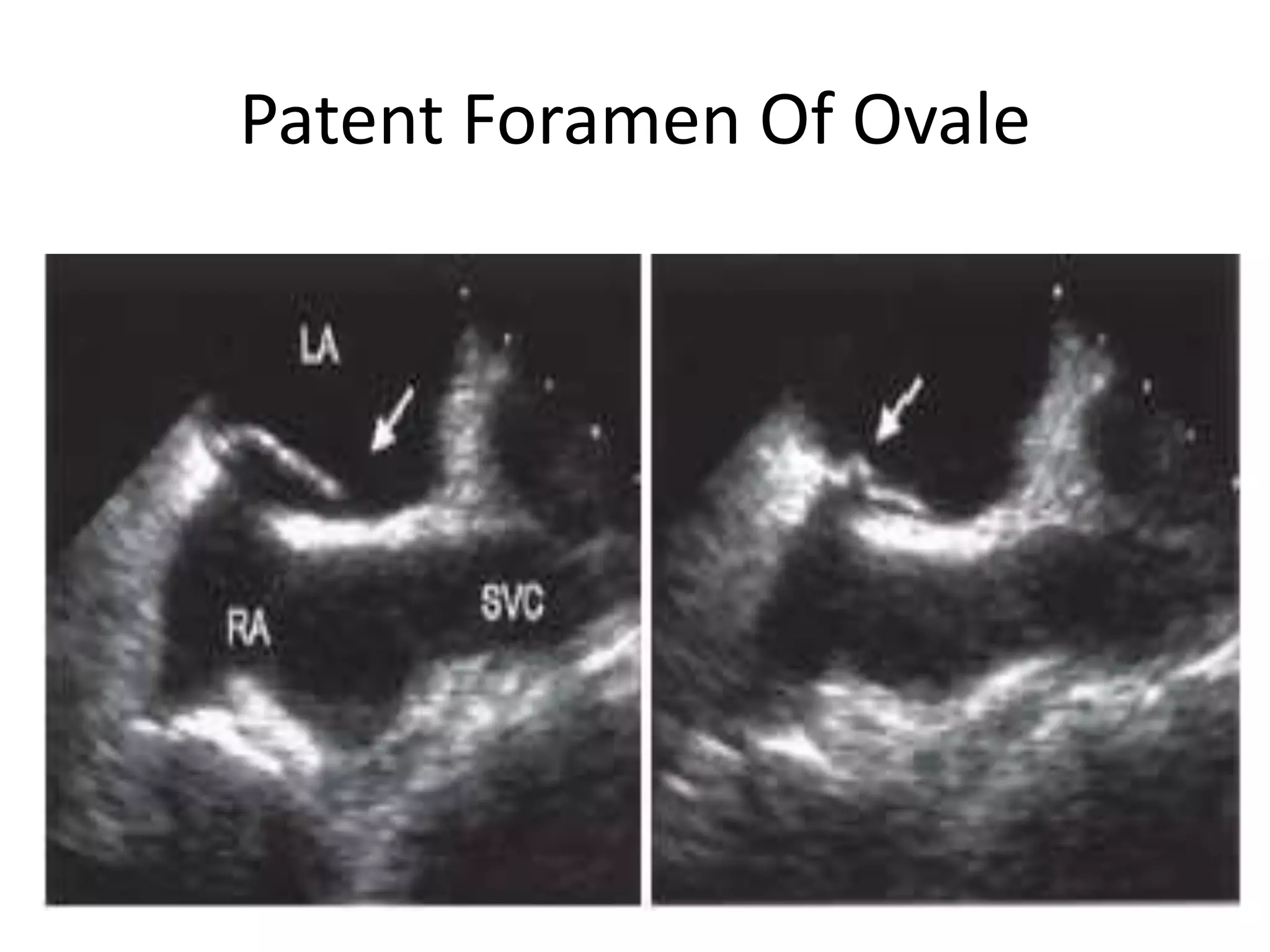 Patent Foramen Of Ovale
 