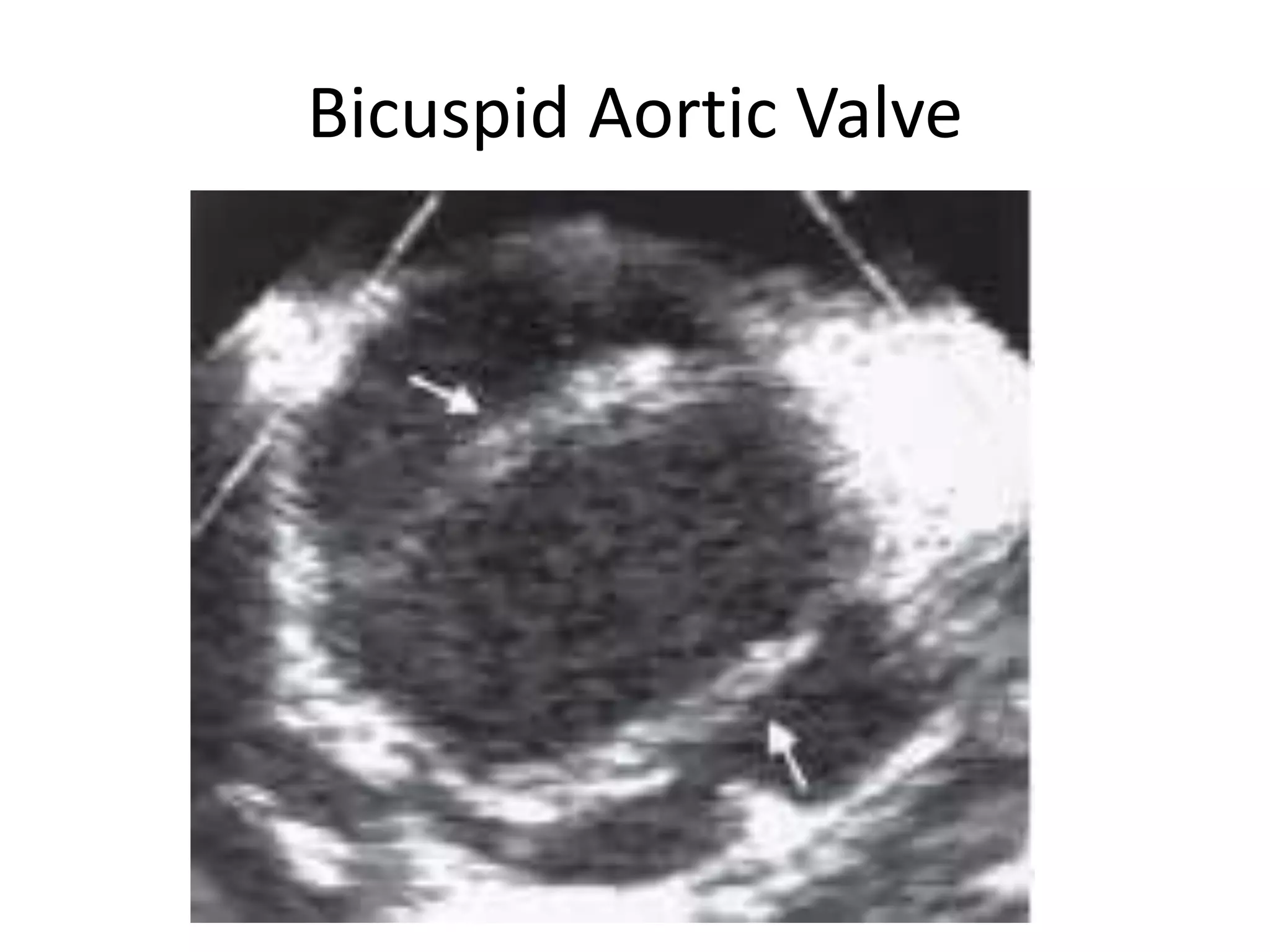 Bicuspid Aortic Valve
 