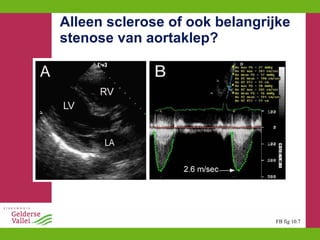 Alleen sclerose of ook belangrijke stenose van aortaklep? FB fig 10.7 