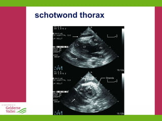 schotwond thorax 