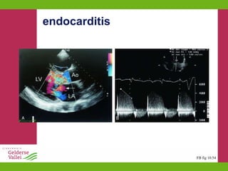 endocarditis FB fig 10.54 