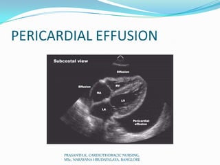 PERICARDIAL EFFUSION
PRASANTH.K, CARDIOTHORACIC NURSING,
MSc, NARAYANA HRUDAYALAYA, BANGLORE
 