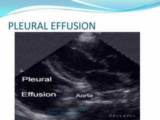 PLEURAL EFFUSION
PRASANTH.K, CARDIOTHORACIC
NURSING, MSc, NARAYANA
HRUDAYALAYA, BANGLORE
 