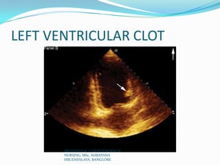 LEFT VENTRICULAR CLOT
PRASANTH.K, CARDIOTHORACIC
NURSING, MSc, NARAYANA
HRUDAYALAYA, BANGLORE
 