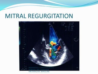MITRAL REGURGITATION
PRASANTH.K, CARDIOTHORACIC
NURSING, MSc, NARAYANA
HRUDAYALAYA, BANGLORE
 