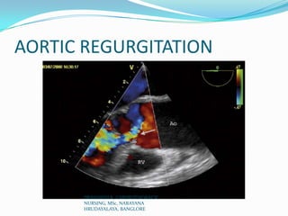 AORTIC REGURGITATION
PRASANTH.K, CARDIOTHORACIC
NURSING, MSc, NARAYANA
HRUDAYALAYA, BANGLORE
 