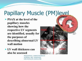 Papillary Muscle (PM)level
 PSAX at the level of the
papillary muscles
showing how the
respective LV segments
are identif...