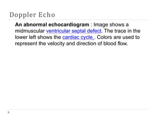 Doppler Echo
An abnormal echocardiogram : Image shows a
midmuscular ventricular septal defect. The trace in the
lower left shows the cardiac cycle . Colors are used to
represent the velocity and direction of blood flow.
 