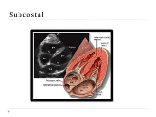 Subcostal
 