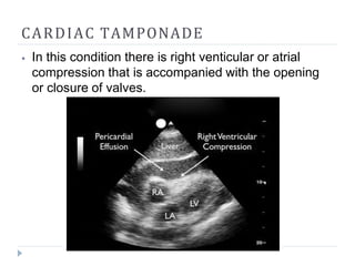 CARDIAC TAMPONADE
⦁ In this condition there is right venticular or atrial
compression that is accompanied with the opening
or closure of valves.
 