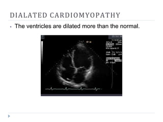 DIALATED CARDIOMYOPATHY
⦁ The ventricles are dilated more than the normal.
 