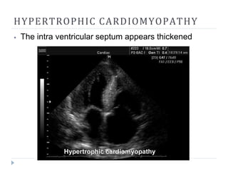 HYPERTROPHIC CARDIOMYOPATHY
⦁ The intra ventricular septum appears thickened
 