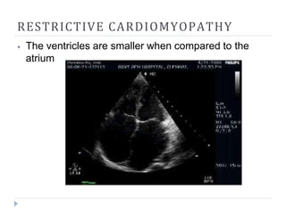 RESTRICTIVE CARDIOMYOPATHY
⦁ The ventricles are smaller when compared to the
atrium
 